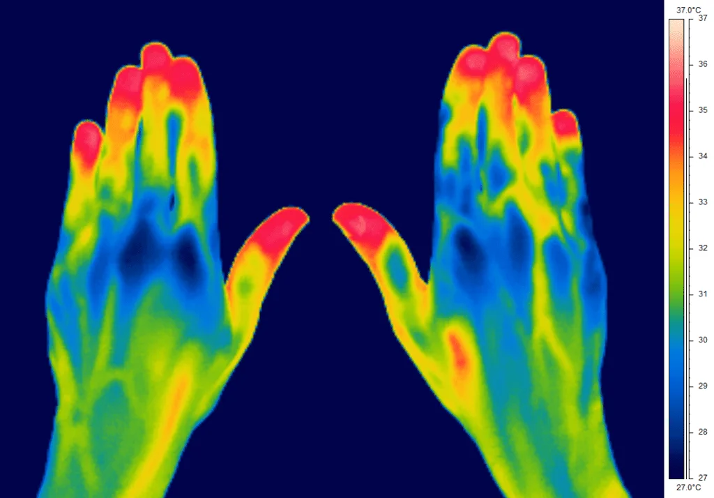 CSTbilathyperaemiaexample Heat Transfer in Container Homes